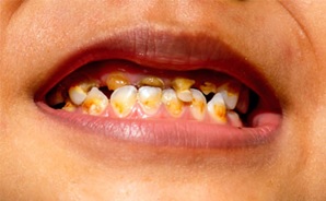 Зубы наркомана
